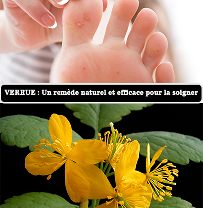 VERRUE : Un remède naturel et efficace pour la soigner